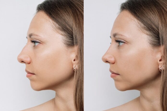 Rhinoplasty